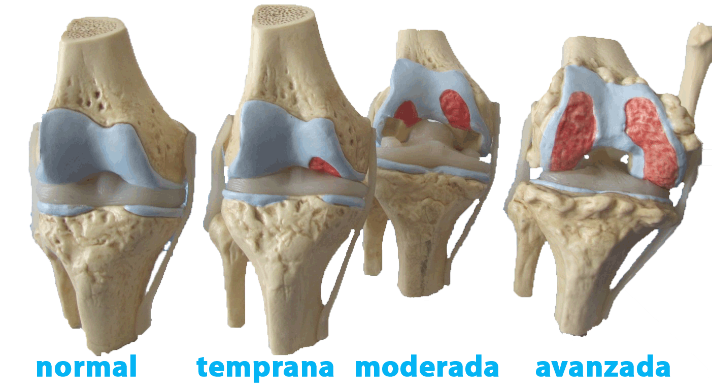 artrosis evolución