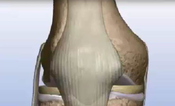 Transplante Meniscal