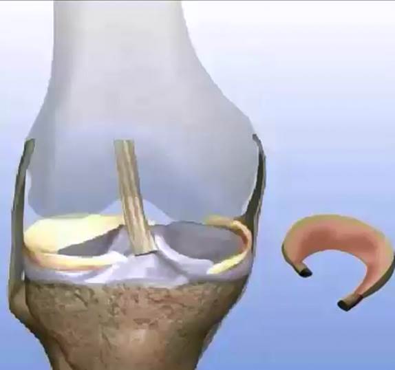 Transplante Meniscal